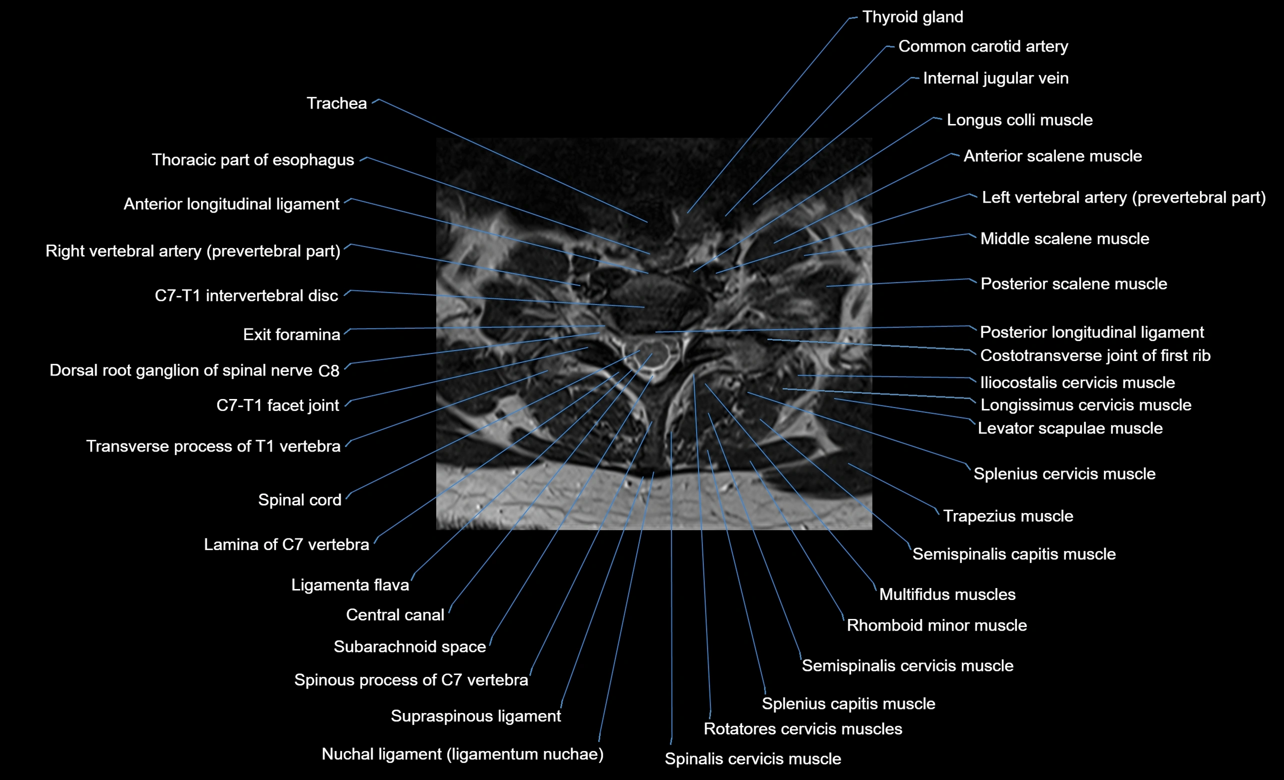cervical spine cross sectional MRI anatomy  3T MRI axial  image-img-00001-00038.webp